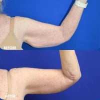 Brachioplasty 01