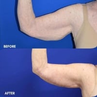 Brachioplasty 01