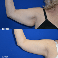 FMPS B&A Template - brachioplasty
