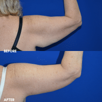 FMPS B&A Template - brachioplasty