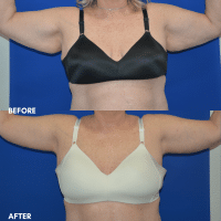 FMPS B&A Template - brachioplasty