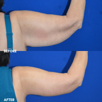 FMPS B&A Template - brachioplasty