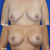 OLD FMPS B&A Template - breast aug with a lift OLD FMPS B&A Template - breast aug with a lift