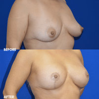 OLD FMPS B&A Template - breast aug with a lift (2) OLD FMPS B&A Template - breast aug with a lift (2)