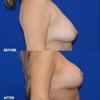 OLD FMPS B&A Template - breast aug with a lift (3) OLD FMPS B&A Template - breast aug with a lift (3)