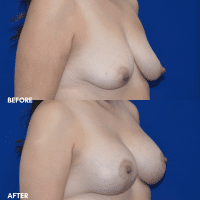 OLD FMPS B&A Template - MASTOPEXY W IMPLANTS (2) OLD FMPS B&A Template - MASTOPEXY W IMPLANTS (2)