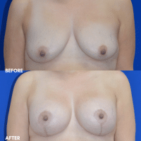 OLD FMPS B&A Template - MASTOPEXY W IMPLANTS OLD FMPS B&A Template - MASTOPEXY W IMPLANTS