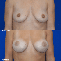 OLD FMPS B&A Template- Sanderson & Braswell Patients - 2025-11-17-breastaugmentation-01
