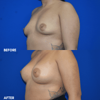 FMPS B&A Template - breast augmentation