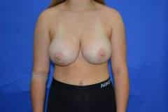 Before Breast Reduction Front