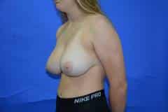 Before Breast Reduction Side