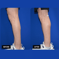 FMPS B&A Template - calf implants  (2)