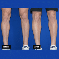 FMPS B&A Template - calf implants