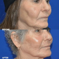 OLD FMPS B&A Template - deep laser resurfacing (2) OLD FMPS B&A Template - deep laser resurfacing (2)