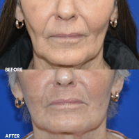 OLD FMPS B&A Template - deep laser resurfacing
