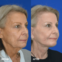 FMPS B&A Template - deep laser resurfacing/ lower face and necklift/ upper bleph (2) FMPS B&A Template - deep laser resurfacing/ lower face and necklift/ upper bleph (2)