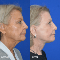 FMPS B&A Template - deep laser resurfacing/ lower face and necklift/ upper bleph (3)
