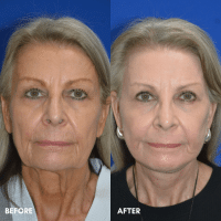 FMPS B&A Template - deep laser resurfacing/ lower face and necklift/ upper bleph FMPS B&A Template - deep laser resurfacing/ lower face and necklift/ upper bleph