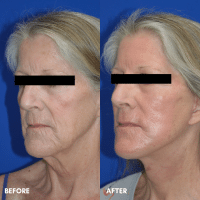 OLD FMPS B&A Template - lower face/ neck lift and deep laser resurfacing (2)