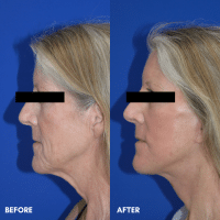 OLD FMPS B&A Template - lower face/ neck lift and deep laser resurfacing (3)
