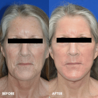 OLD FMPS B&A Template - lower face/ neck lift and deep laser resurfacing