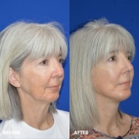 FMPS/CFPS B&A Templates  -  Lower face/Neck lift deep plane Sanderson