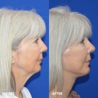 FMPS/CFPS B&A Templates  - Lower face/Neck lift deep plane Sanderson