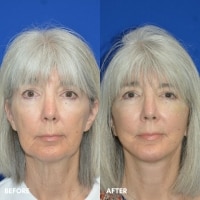 FMPS/CFPS B&A Templates  - Lower face/Neck lift deep plane Sanderson