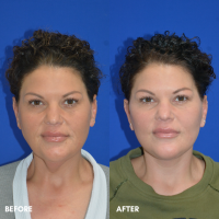 OLD FMPS B&A Template- Sanderson & Braswell Patients - 2025-12-15-deepplanefacelift-01 (3)