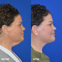 OLD FMPS B&A Template- Sanderson & Braswell Patients - 2025-12-15-deepplanefacelift-01