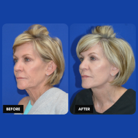 OLD FMPS B&A Template- Sanderson & Braswell Patients - 2026-2-4-deepplanefaceandnecklift-01 (2)