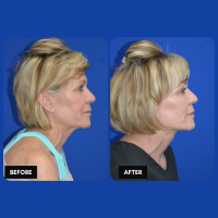 OLD FMPS B&A Template- Sanderson & Braswell Patients - 2026-2-4-deepplanefaceandnecklift-01 (3)