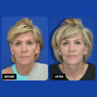 OLD FMPS B&A Template- Sanderson & Braswell Patients - 2026-2-4-deepplanefaceandnecklift-01