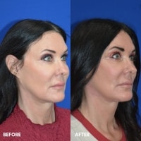 FMPS/CFPS B&A Templates  -  Lower face/Neck lift deep plane Sanderson
