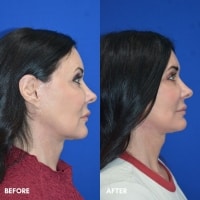 FMPS/CFPS B&A Templates  - Lower face/Neck lift deep plane Sanderson
