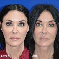 FMPS/CFPS B&A Templates  - Lower face/Neck lift deep plane Sanderson