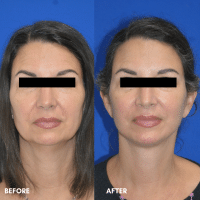 OLD FMPS B&A Template - deep plane face and necklift OLD FMPS B&A Template - deep plane face and necklift