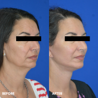 OLD FMPS B&A Template - deep plane face and necklift (2) OLD FMPS B&A Template - deep plane face and necklift (2)