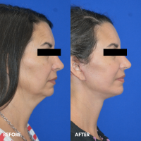 OLD FMPS B&A Template - deep plane face and necklift (3) OLD FMPS B&A Template - deep plane face and necklift (3)