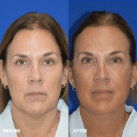 OLD FMPS B&A Template - deep plane face and necklift OLD FMPS B&A Template - deep plane face and necklift