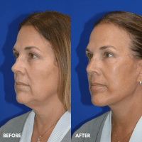 OLD FMPS B&A Template - deep plane face and necklift (2) OLD FMPS B&A Template - deep plane face and necklift (2)