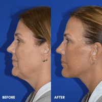 OLD FMPS B&A Template - deep plane face and necklift (3) OLD FMPS B&A Template - deep plane face and necklift (3)
