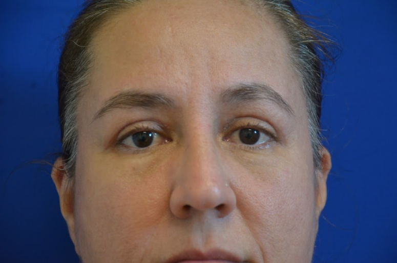 Before & After Face Flower Mound Plastic Surgery