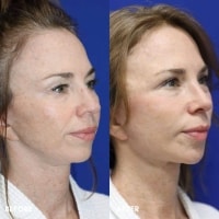 FMPS/CFPS B&A Templates  - Mini Face Lift Sanderson (2)