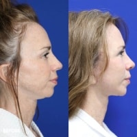 FMPS/CFPS B&A Templates  - Mini Face Lift Sanderson