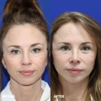 FMPS/CFPS B&A Templates  - Mini Face Lift Sanderson