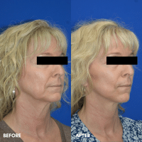FMPS B&A Template - Mini facelift