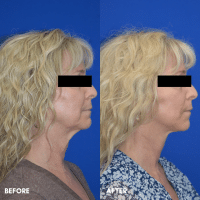 FMPS B&A Template - Mini facelift