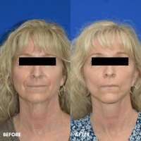 FMPS B&A Template - mini facelift