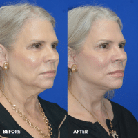 FMPS B&A Template - lower face and neck lift (2) FMPS B&A Template - lower face and neck lift (2)